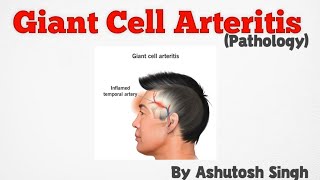 Giant Cell Arteritis Temporal Arteritis Pathology [upl. by Kyrstin]