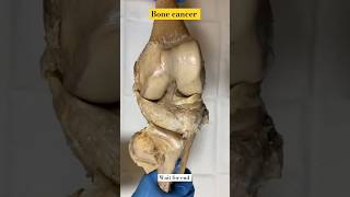 The Scary Truth About Bone Cancer ytshorts facts shorts [upl. by Bornstein2]