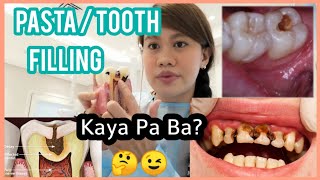 MALAKING SIRA NG NGIPIN KAYA PA BA PASTAHAN tooth filling dental clinic in kuwait [upl. by Rust]