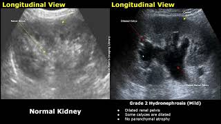 Hydronephrosis Grading Ultrasound  Kidney USG Scan Normal Vs Abnormal Images  Grades 1 2 3 amp 4 [upl. by Chavez812]