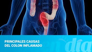 Principales causas del colon inflamado [upl. by Macario]