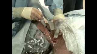 Placement of Central Venous Catheter  NEJM [upl. by Whit]