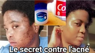 Comment enlever les boutons et taches noires sur le visage [upl. by Allemac]