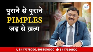 मुँहासे खत्म करने का रामबाण इलाज  How To Remove Pimples Overnight  Acne Treatment amp Medicines [upl. by Bay]