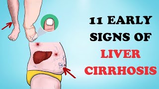 11 Early Signs of Liver Cirrhosis  Healthy Care [upl. by Dreher]