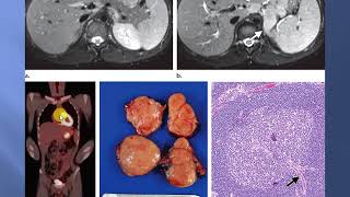 solid tumors of the peritoneum omentum and mesentery [upl. by Jacinta736]