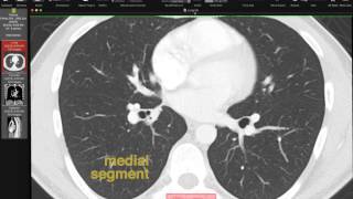 Lobar and Segmental Lung Anatomy on CT [upl. by Cope51]