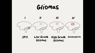 Doctor Explains Glioma Brain Tumor [upl. by Duile]