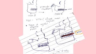 Working Bite Construction Bite ORTHO BASICS [upl. by Elimac]