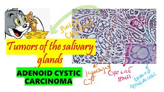 Adenoid cystic Carcinoma HISTOPATHOLOGY  Clinical features DETAILED Oral pathology  NEET MDS [upl. by Giza490]