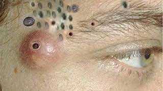 Big Cystic Acne Blackheads Extraction Blackheads amp Milia Whiteheads Removal Pimple Popping 0251 [upl. by Nnayrb34]