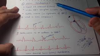 Clinical ECG Interpretation in Bangla Part9 WPW Syndrome Ventricular EctopicsHypoampHyperkalemia [upl. by Ahsirat]