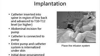 Intrathecal Baclofen Therapy for Spasticity [upl. by Wescott]