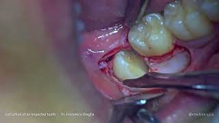 PIEZOSURGERY®  Dr Oreglia  Mandibular Impacted Third Molar Extraction with Piezo Technique [upl. by Chariot680]