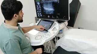 Scrotal Ultrasound  Hydrocele  microlithiasis [upl. by Hakilam]