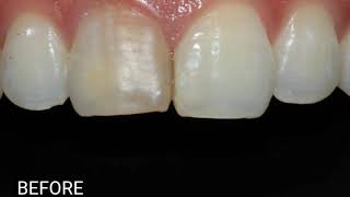 Enhance your smile with Ceramage Veneers [upl. by Arbrab]