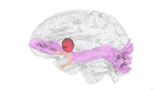 3Dimensional Reconstruction of Dominant Hemisphere Gliomas [upl. by Eigriv]