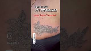 madinkers lasertattooremovalspecialist lasertattooremoval youtubeshorts youtube Follow us 🙏 [upl. by Toddy125]