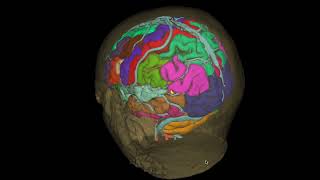 Cavernoma parietal [upl. by Atsahc]