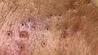 Blackheads amp Whiteheads Satisfying Removal 0014 [upl. by Kenric658]