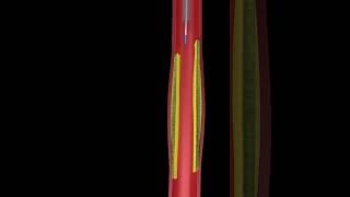 Learn How Angioplasty Works Animated Video [upl. by Tibold600]