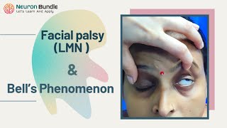 Bell’s Phenomenon amp LMN Facial Bell’s Palsy  Clinical features LMNvsUMN cranialnerveexam [upl. by Rusticus]