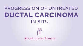 Progression of Ductal Carcinoma in Situ [upl. by Marian334]