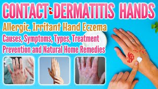 Contact dermatitis hands types causes symptoms treatment home remedy  eczema on hands [upl. by Odnama]