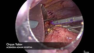 Laparoscopic Proximal Gastrectomy with Double Tract Anastomosis [upl. by Odnomor]