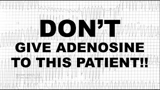 Dont Give Adenosine To This Patient [upl. by Allicirp]