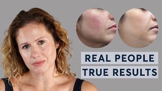 ProfhiloHydro Deluxe  Real People True Results [upl. by Staford685]