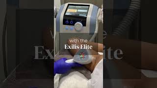 Sagging Arms Begone with Exilis Elite [upl. by Eannyl]