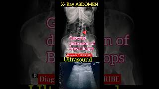 Gaseous distension of bowel loops  X  Ray Abdomen amp USS Abdomen  Diagnosis  Radiology [upl. by Anneiv757]