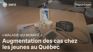 Augmentation des cas de la « maladie qui momifie » au Québec [upl. by Marka]