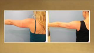 Laser Lipo for Slimmer Arms  Testimonial [upl. by Ajnotal]