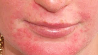 Home Remedies for Perioral Dermatitis [upl. by Krik]