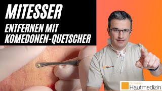 Mitesser entfernen mit Komedonenquetscher Wie geht das  Dr Kasten Hautmedizin in Mainz mitesser [upl. by Eiroj984]