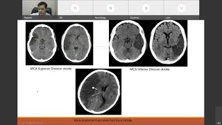 Stroke Clinical Approach amp Localization [upl. by Nissensohn501]