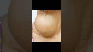 Goiter Huge Thyroid Growth in Someone’s Neck [upl. by Onairda965]