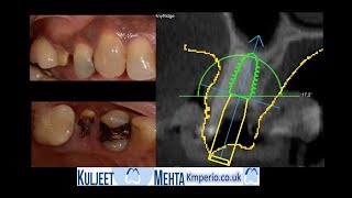 Extraction amp Immediate AnyRidge Implant [upl. by Perrin]