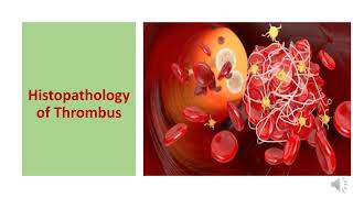 THROMBOSIS TYPES  HISTOPATHOLOGY CONSEQUENCES DIAGNOSIS AND PREVENTION [upl. by Egiarc]