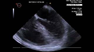 Aneurysm of the Anterior Mitral Valve Leaflet amp Multiple Vegetations on Aortic and Mitral Valves [upl. by Ahsined]