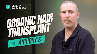 Anthonys Experience I Organic Hair Transplant I Estetik International [upl. by Acnaiv683]