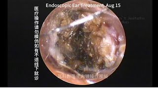 External auditory canal cholesteatoma misdiagnosed as cerumen embolism [upl. by Rramaj444]