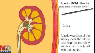 Percutaneous Nephrolithotomy [upl. by Alitha435]