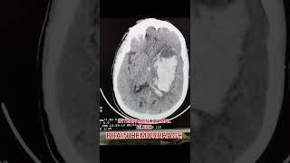 Brain Hemorrhage bleed radiology brain shortvideo [upl. by Gerfen217]