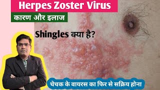 Herpes Zoster Shingles Disease Cause Symptoms and Treatment in Hindi  Varicella Zoster Virus [upl. by Ninette139]