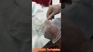 PCN Catheter how to Connected Percutaneous Nephrostomy Catheter with Urine bag without connector [upl. by Bradan]