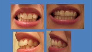 INVISALIGN Update Tray 21 last tray amp Refinements [upl. by Atnim]