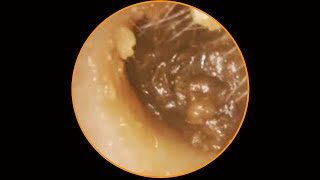 Tympanic membrane perforation and postoperative debridement for cholesteatoma 49 [upl. by Dahlia718]